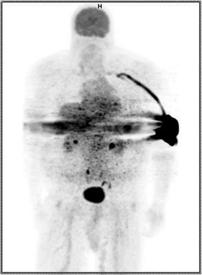 Case Report: Radiopharmaceutical extravasation, radiation paranoia, and chilling effect